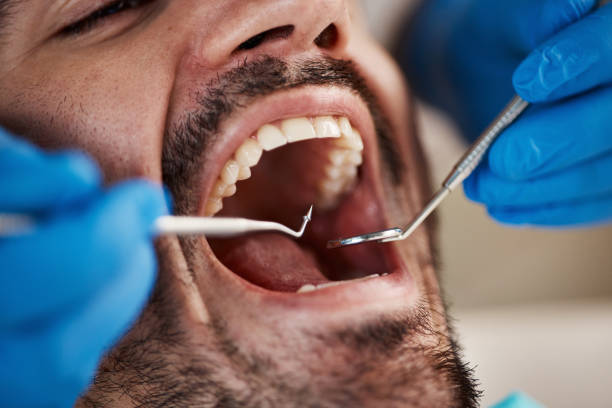 Best Emergency Tooth Extraction in Rockdale, TX